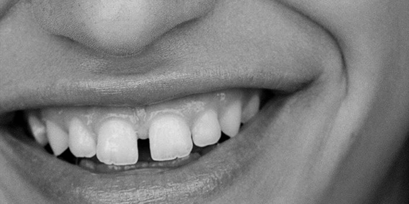 dientes-cortos-desgastados-solucion