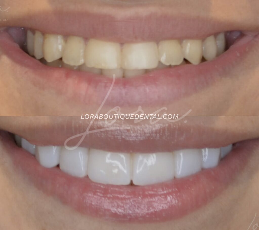 Antes y después de un blanqueamiento dental con carillas en Lora Boutique Dental en Barcelona