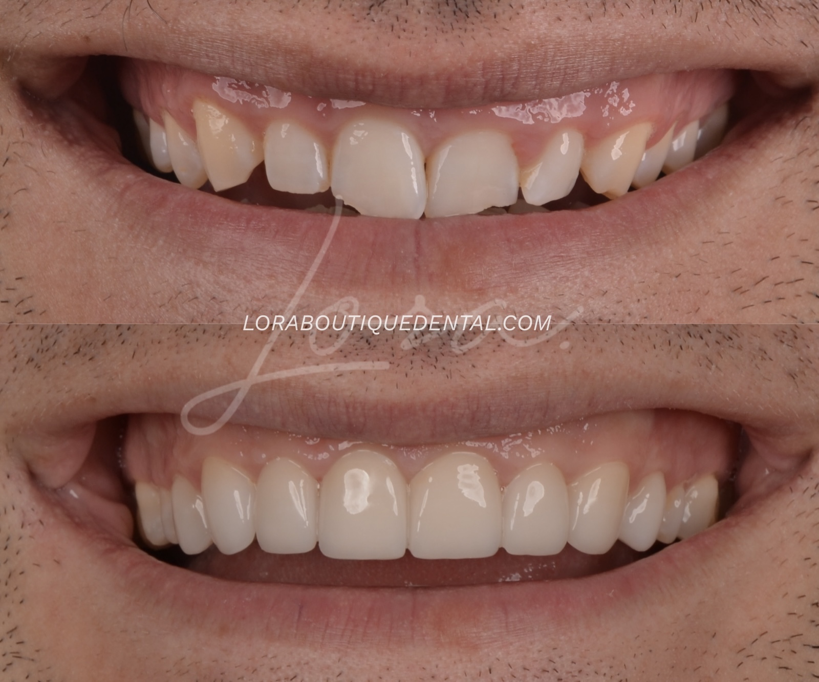 Persona sonriendo mostrando sus dientes luego de invisalign, blanqueamiento dental y carillas